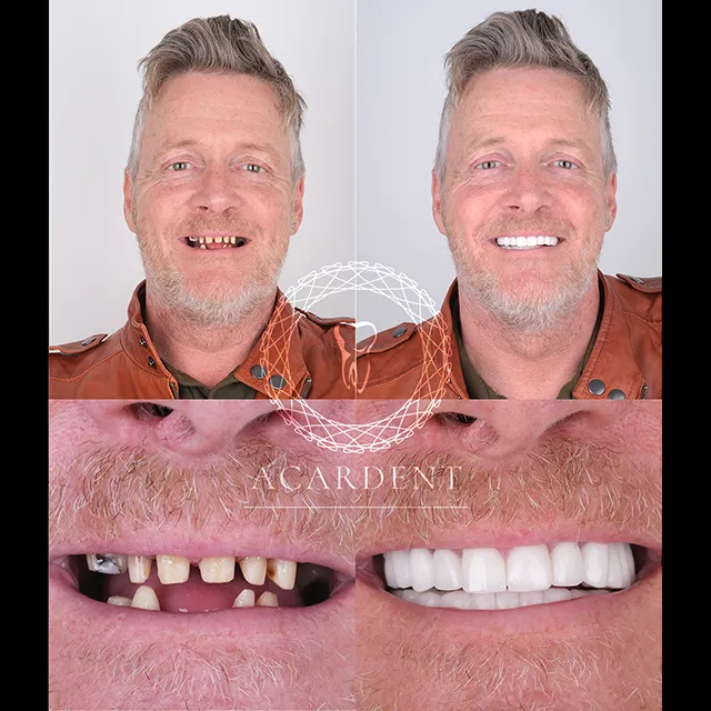  What are the advantages of implant teeth, before-after Antalya 