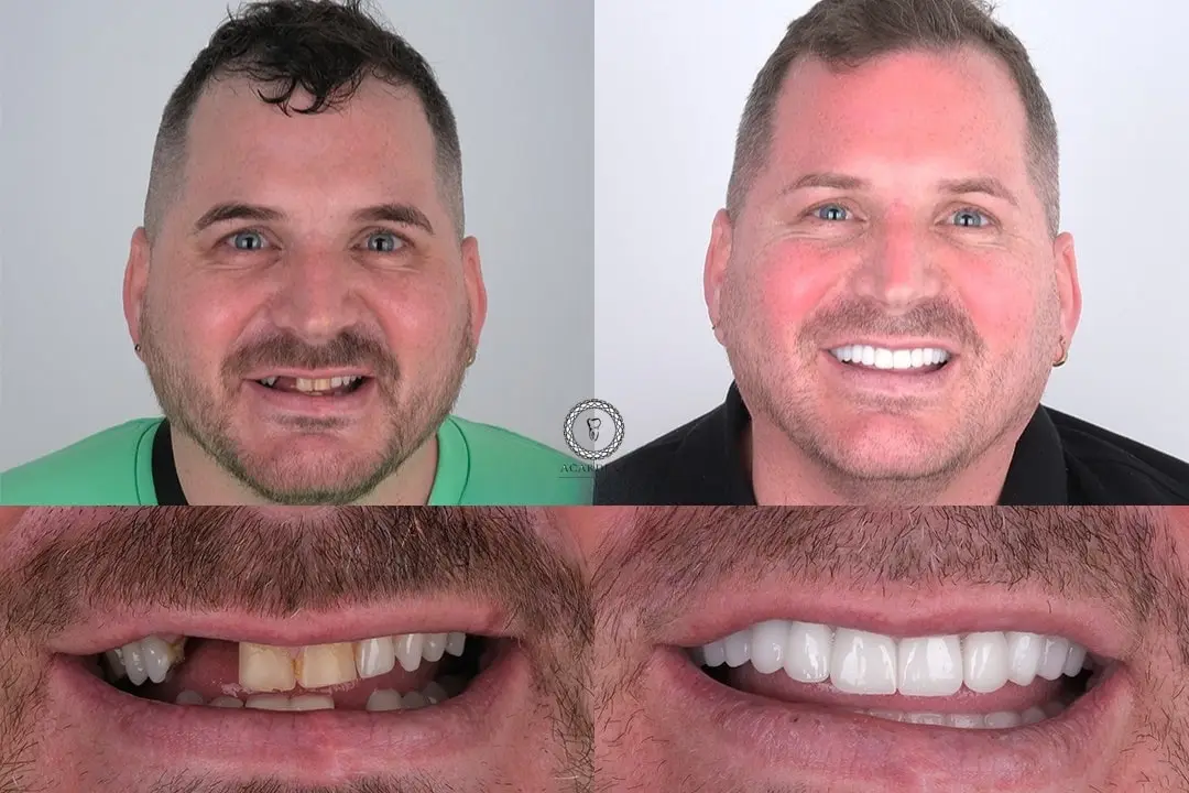 Dental implants before after Antalya, Turkey
