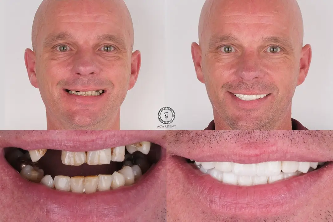 Before and after Turkey teeth implants