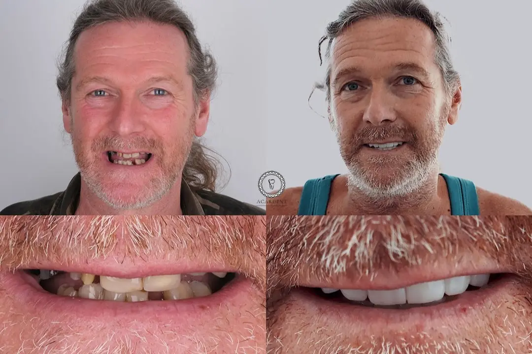 Dental implants before after Antalya, Turkey