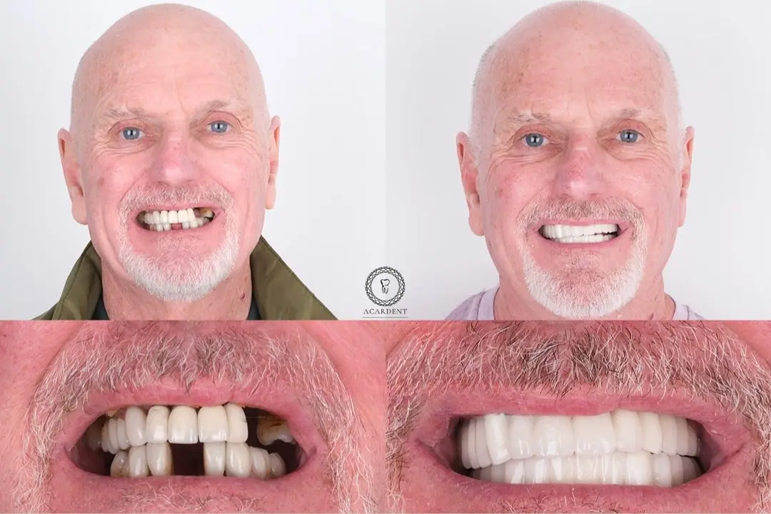 Dental implants before after Antalya, Turkey