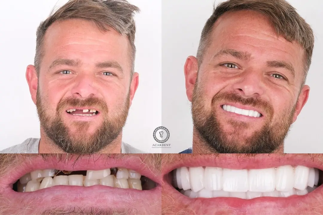 Dental implants before after Antalya, Turkey