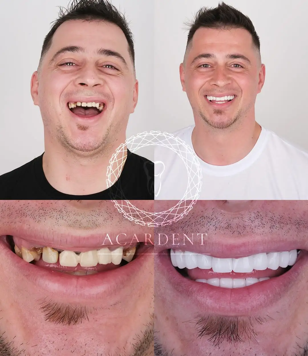 What are dental implants in Turkey?