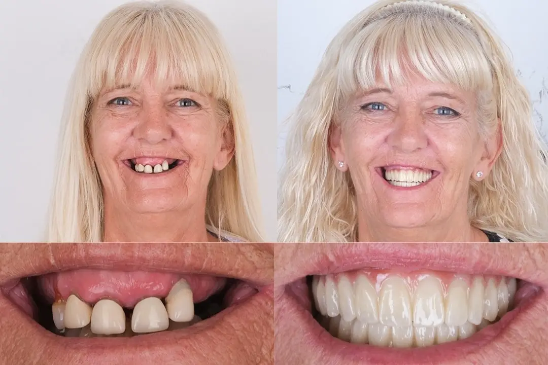 Before After all-on-4 & all-on-6 dental implants in Antalya, Turkey