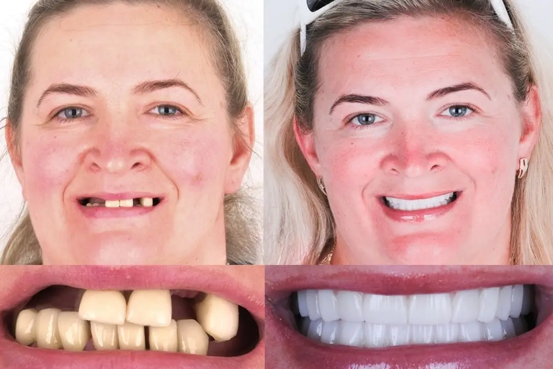 Before After all-on-4 & all-on-6 dental implants in Antalya, Turkey