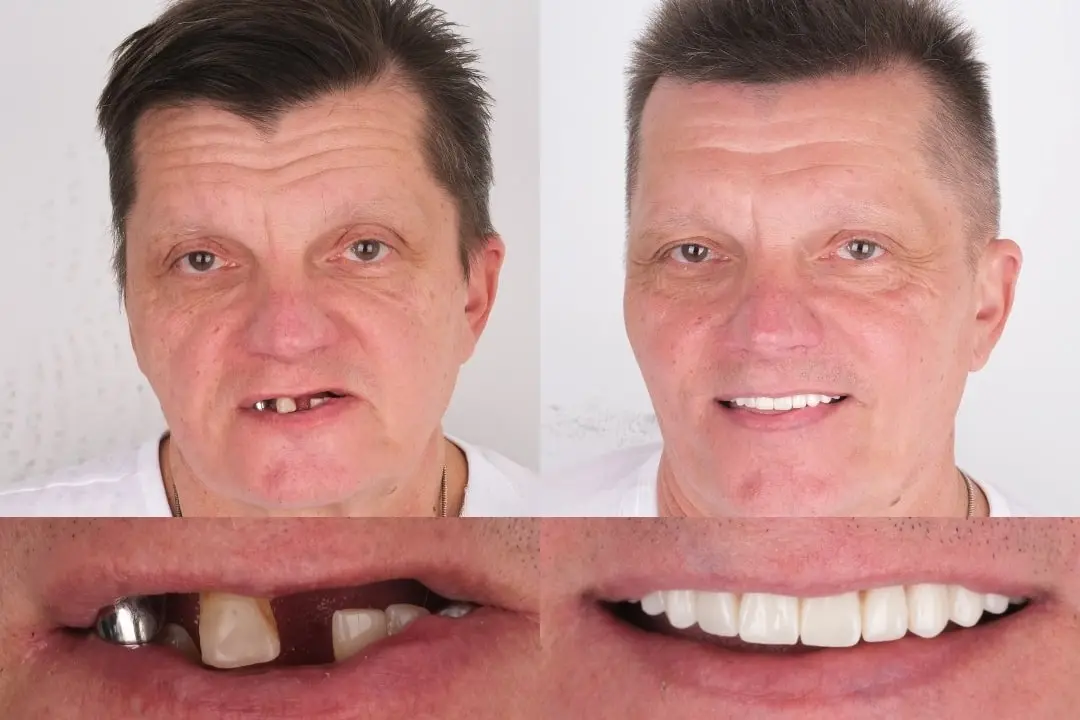 Before After all-on-4 & all-on-6 dental implants in Antalya, Turkey