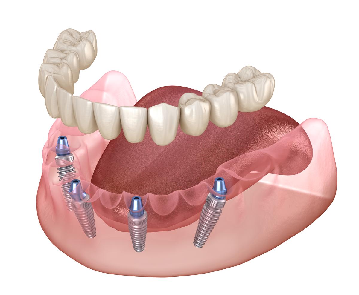 all-on-4-dental-implants-antalya-turkey-tooth-implant