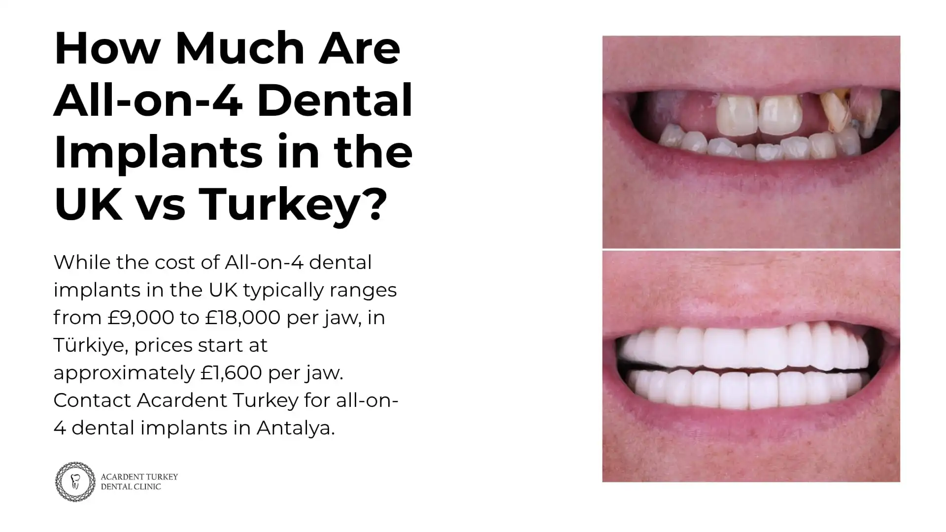 How Much Are All-on-4 Dental Implants in the UK vs Turkey?