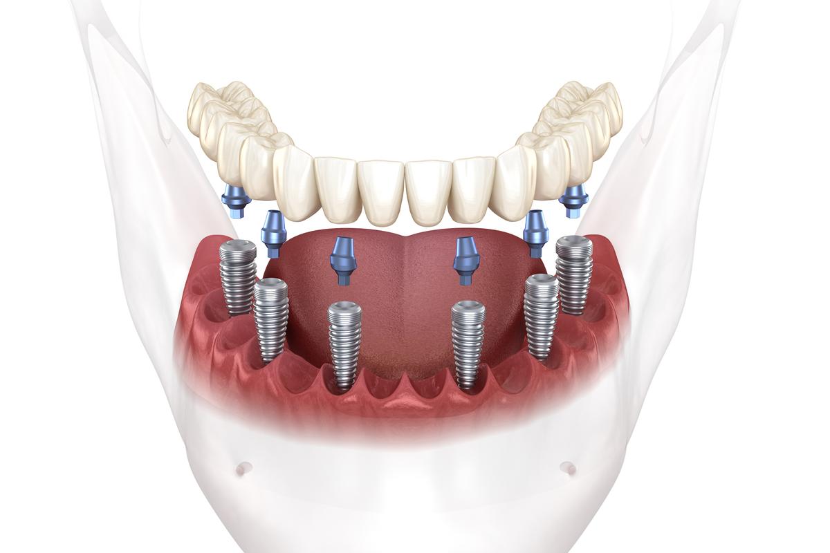 all-on-6-dental-implants-antalya-turkey-tooth-implant