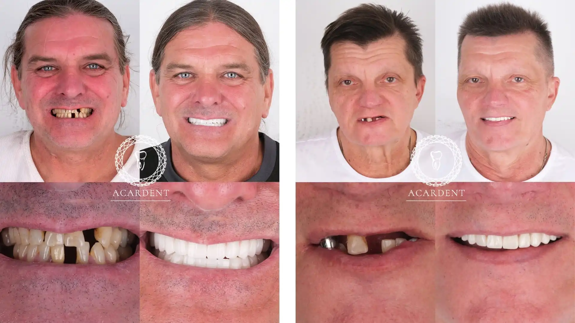 All on 4 dental implants before & after in Turkey - 1