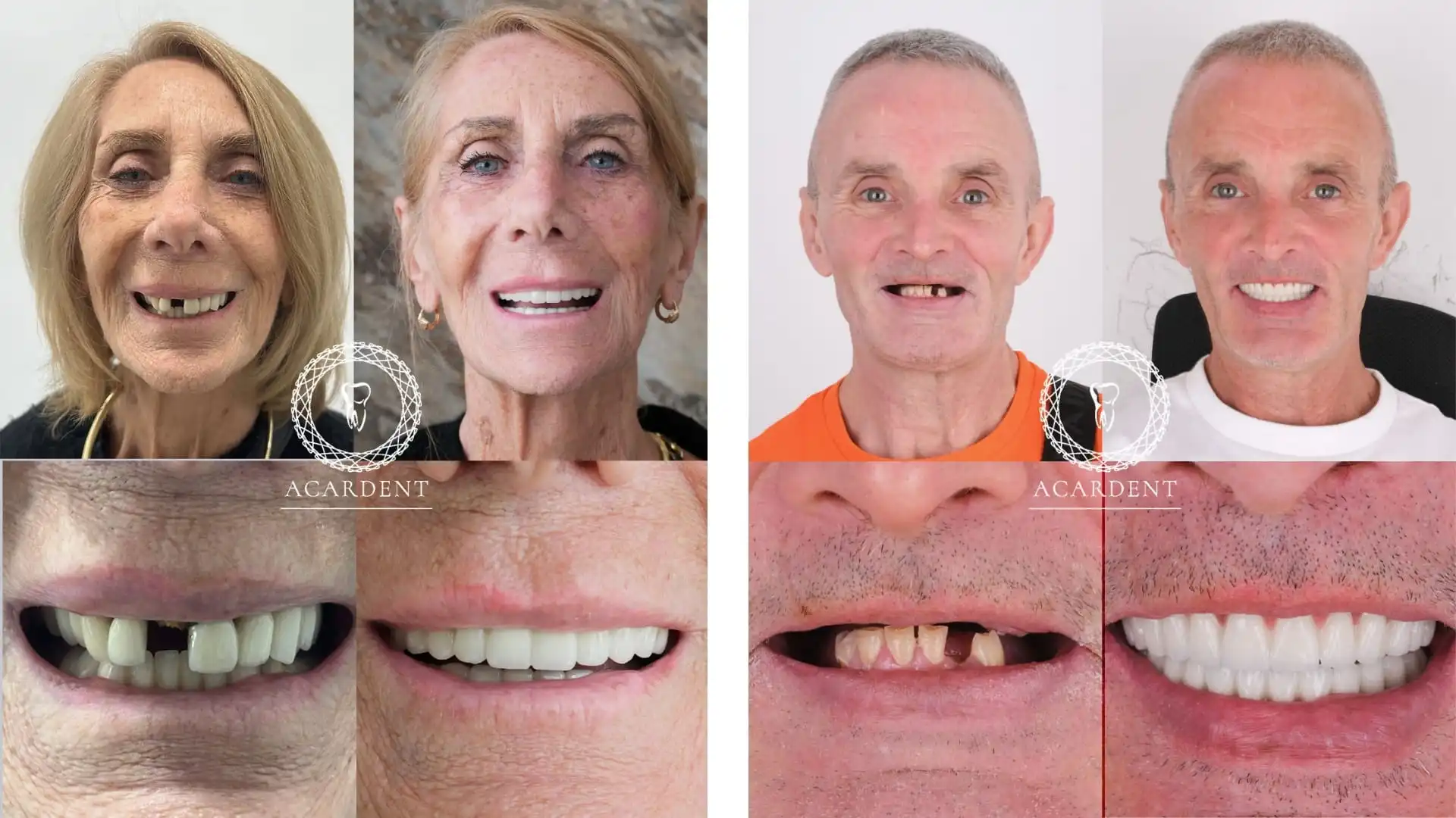 All on 4 dental implants before & after in Turkey - 2