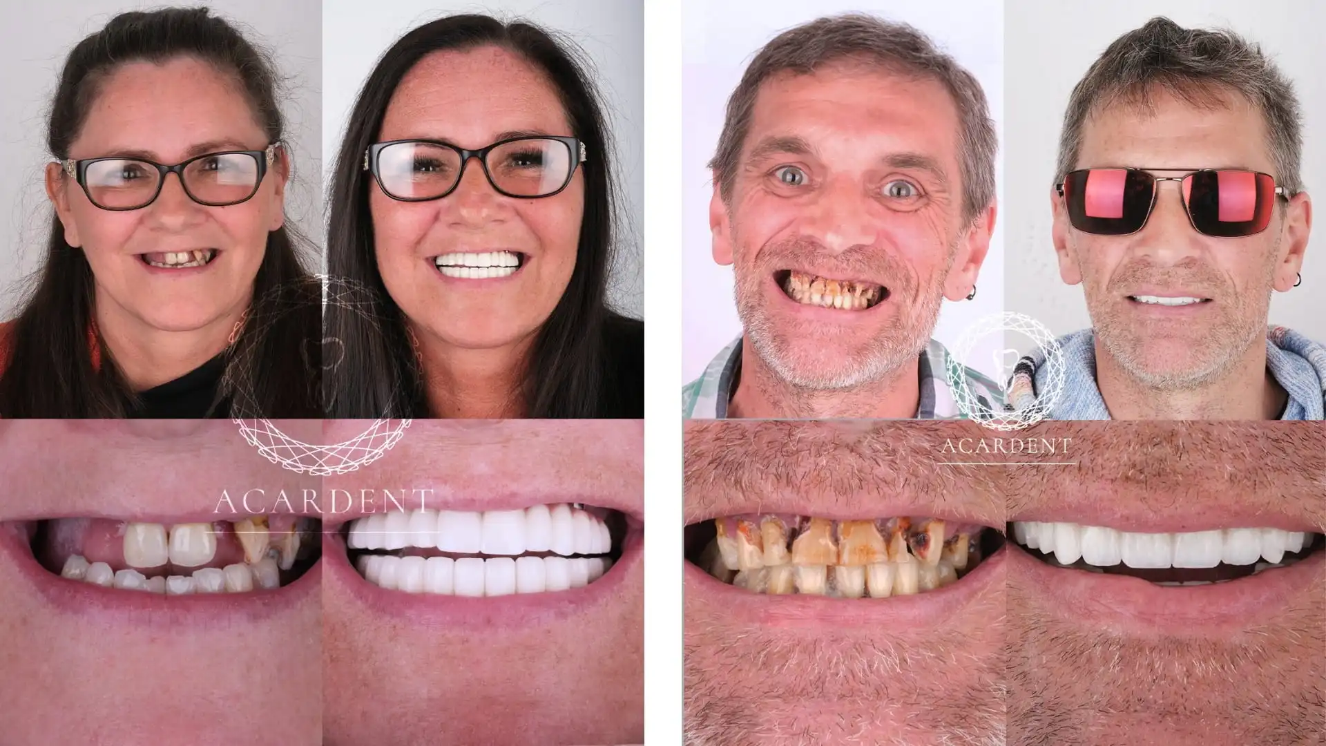 All on 4 dental implants before & after in Turkey - 3