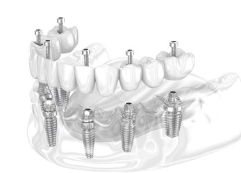 all-on-6-dental-implants-antalya-turkey-tooth-implant