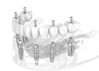 all-on-6-dental-implants-antalya-turkey-tooth-implant