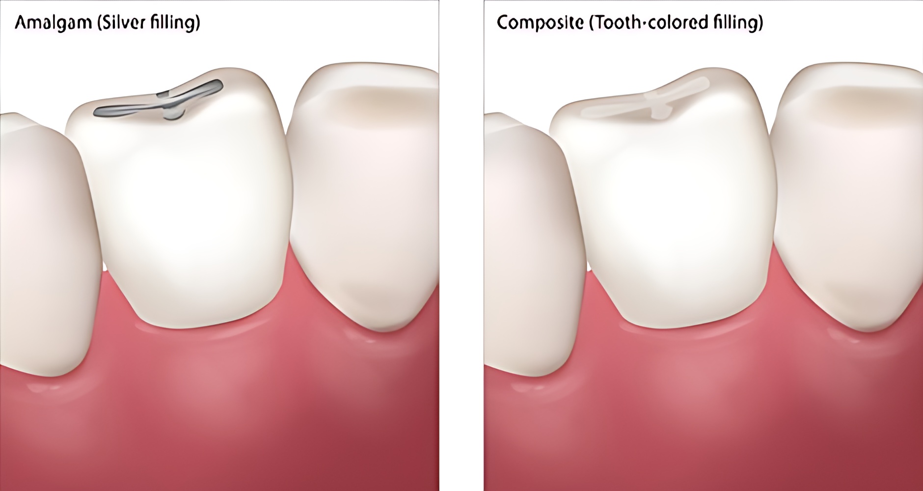 amalgam-fillings-and-aesthetic-tooth-fillings-antalya-turkey