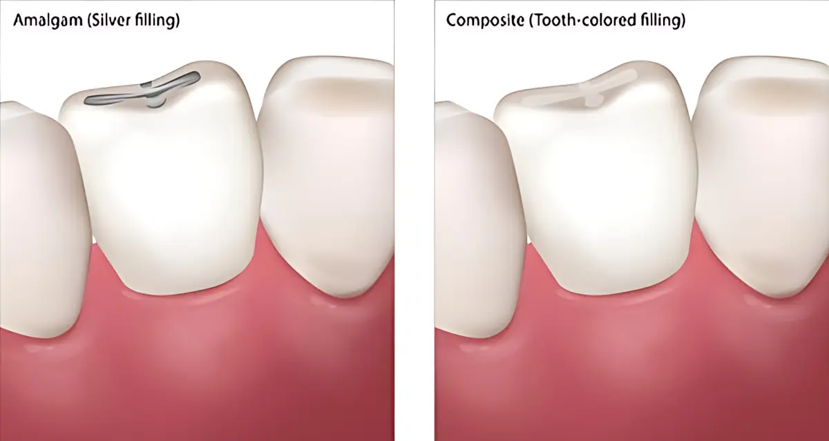 amalgam-fillings-and-aesthetic-tooth-fillings-antalya-turkey