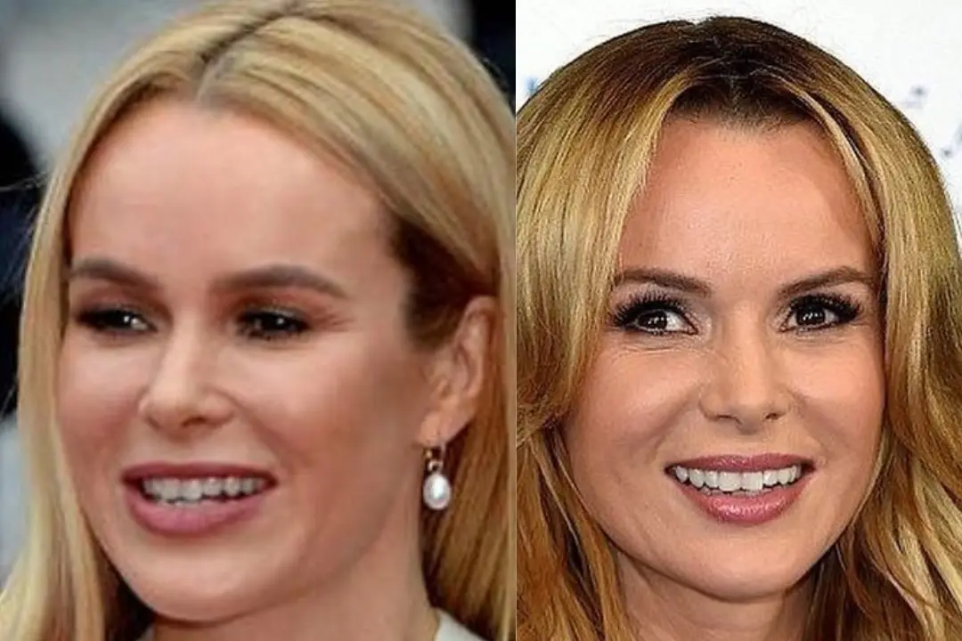 Amanda Holden teeth Antalya, Turkey