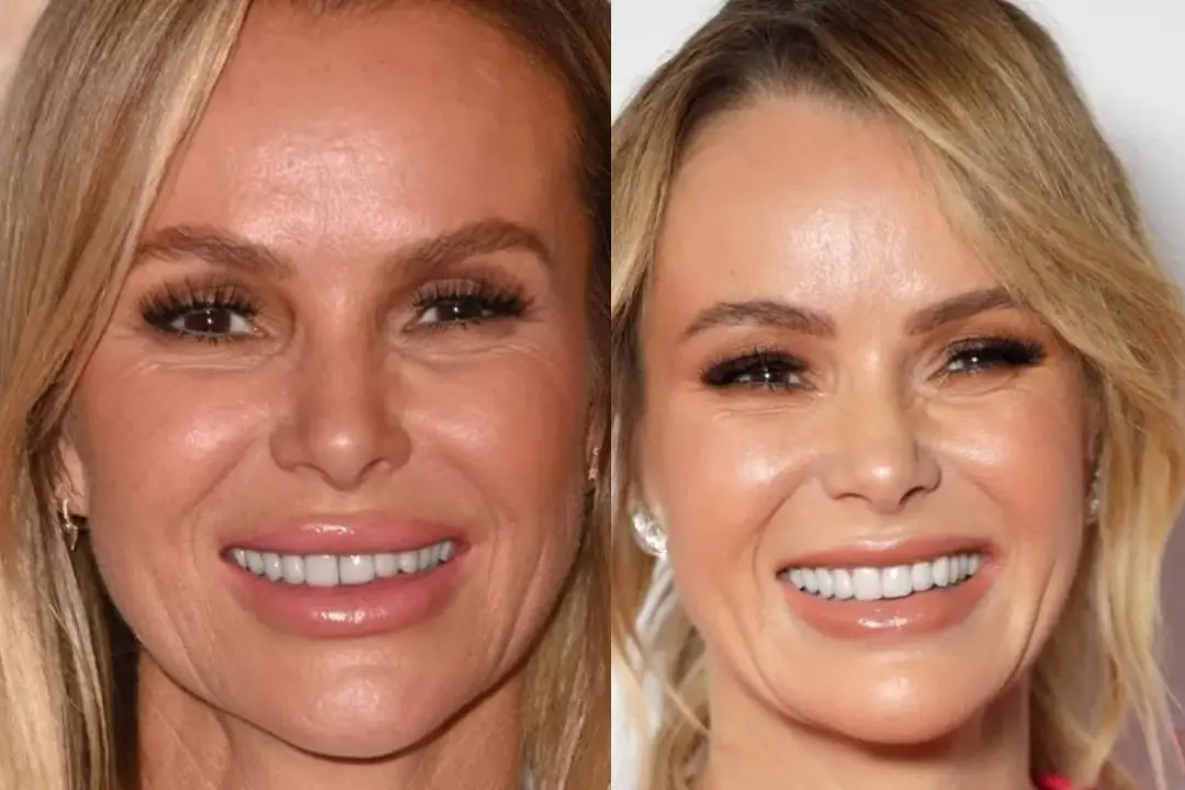 Amanda Holden teeth Antalya, Turkey