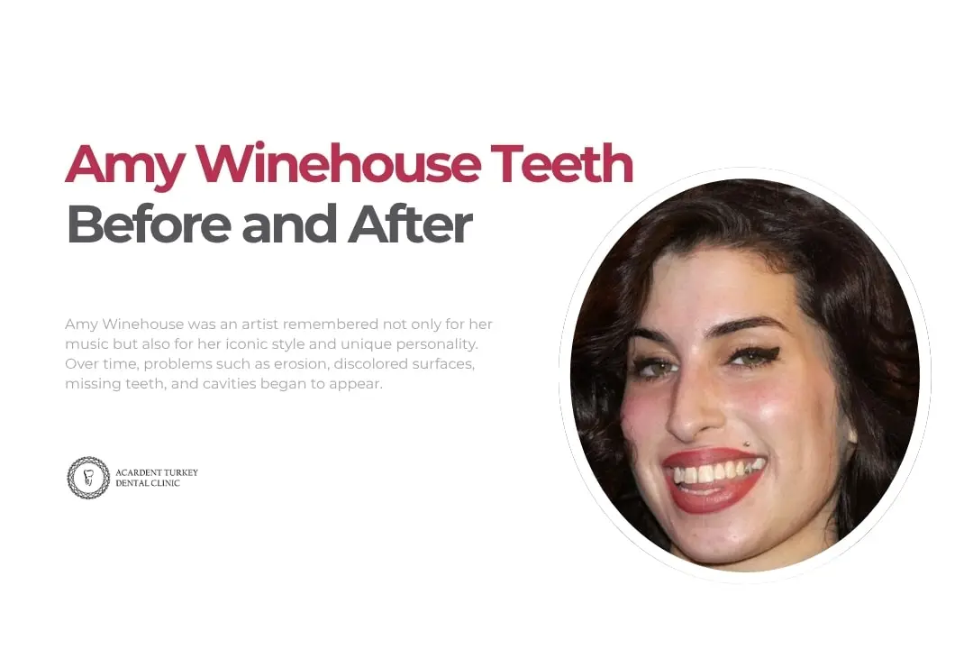 Amy Winehouse teeth before after