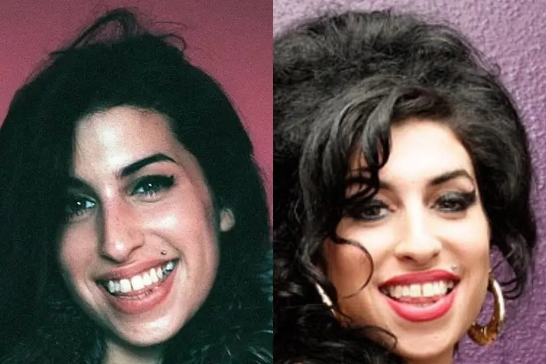 Dental implants before after Antalya, Turkey