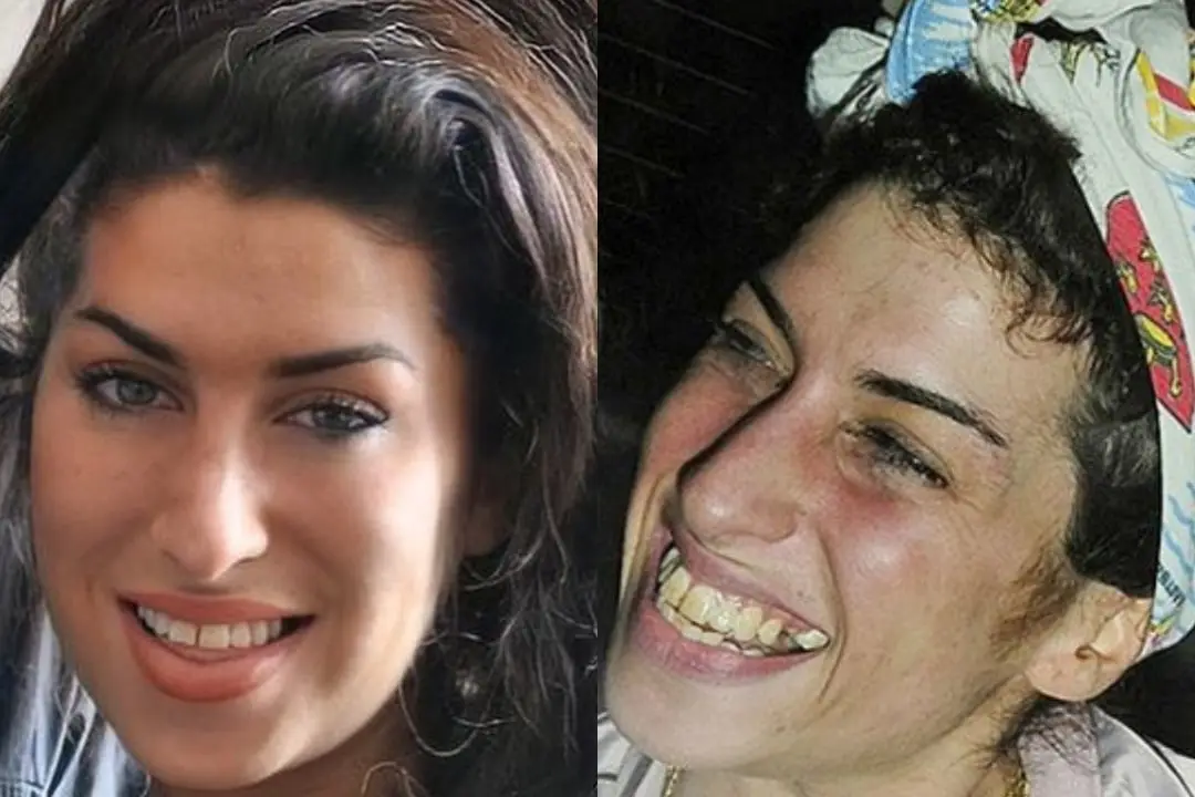 Dental implants before after Antalya, Turkey