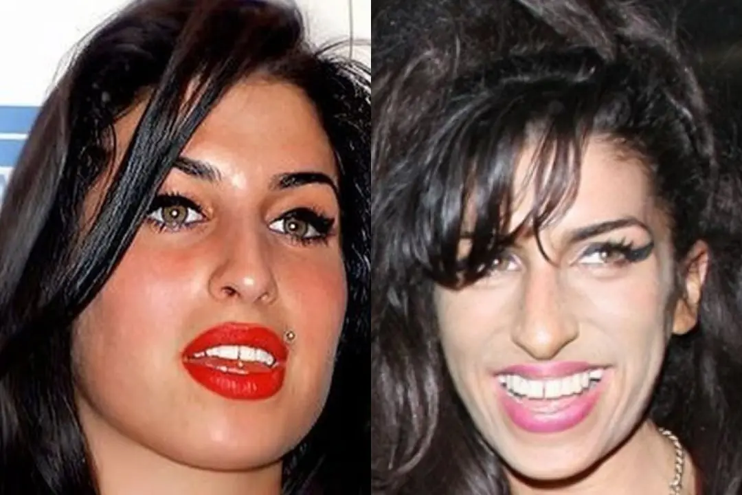 Dental implants before after Antalya, Turkey