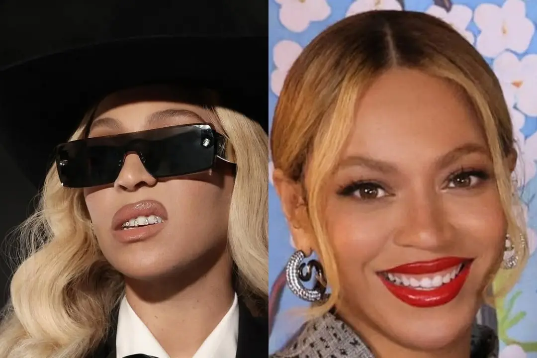 Beyoncé teeth before and after Beyoncé teeth before-after Antalya, Turkey