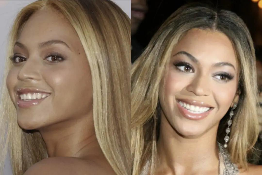 Beyoncé teeth veneers before and after Beyoncé teeth veneers Antalya, Turkey