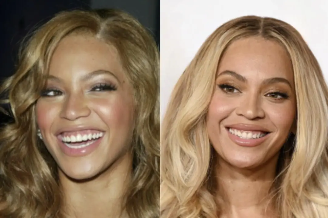 Beyoncé teeth veneers before and after Beyoncé teeth veneers Antalya, Turkey
