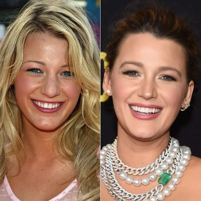 Celebrity veneers before and after Antalya, Turkey