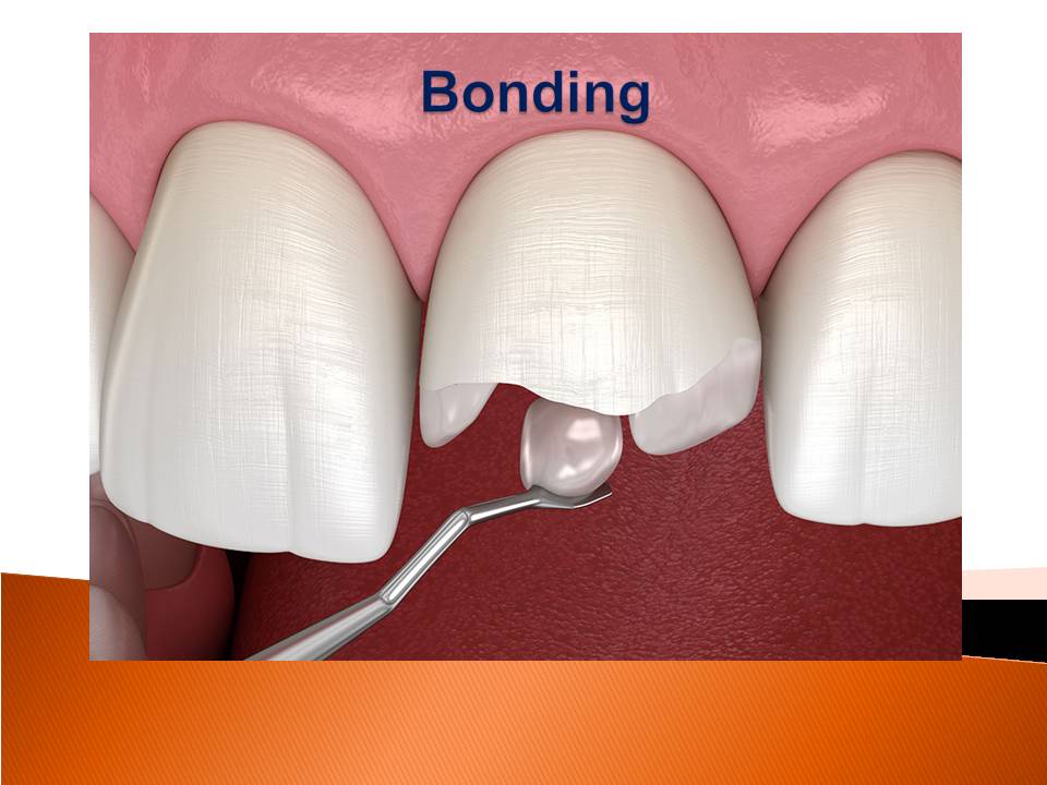 Composite Bonding Antalya Turkey