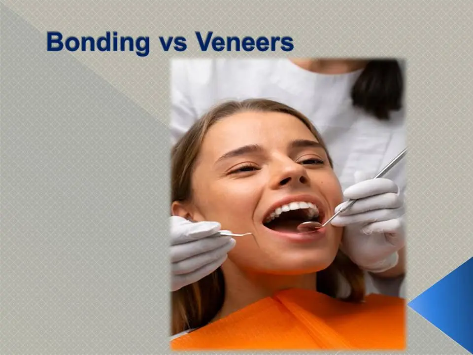 Composite vs Veneers Antalya Turkey