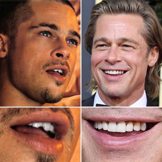 Bradd Pitt Celebrity veneers before and after Antalya, Turkey