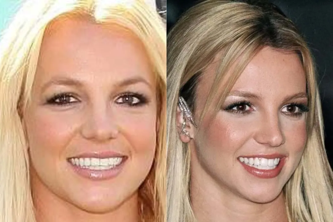 Britney Spears teeth veneer before and after Britney Spears teeth veneer before and after Antalya, Turkey