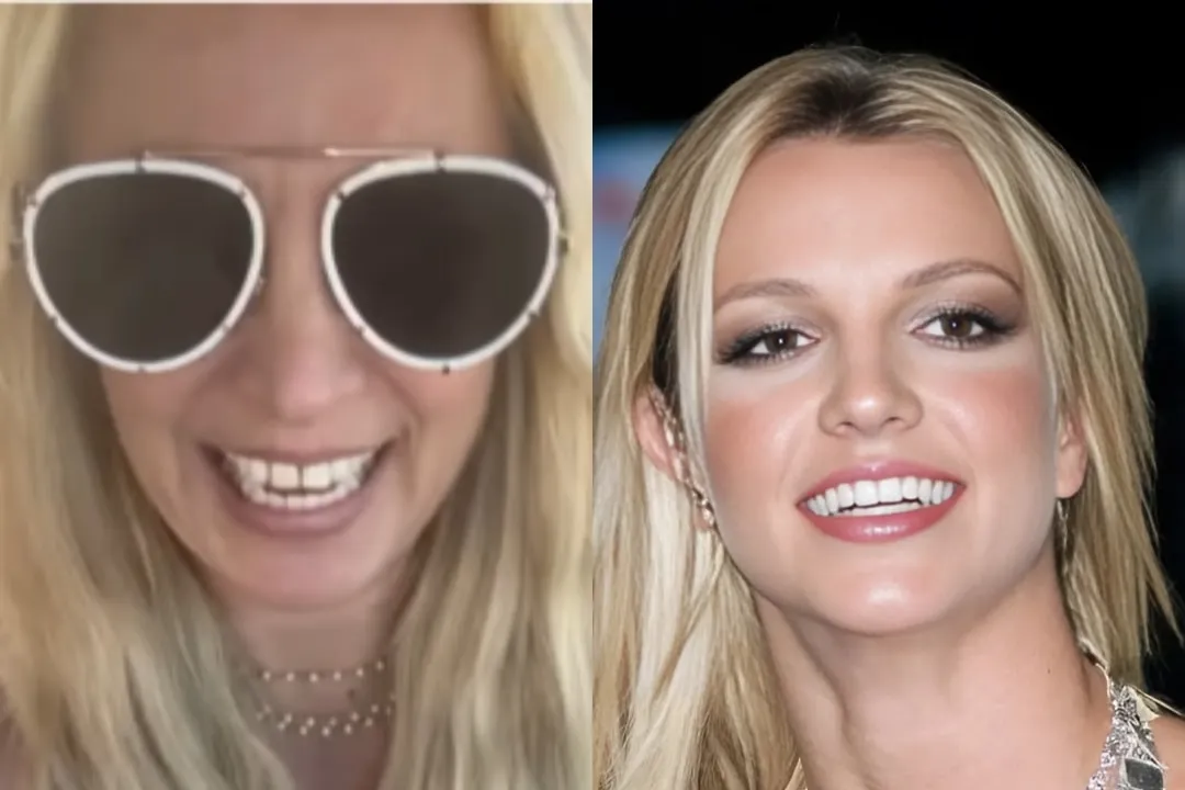 Britney Spears teeth veneer before and after Britney Spears teeth before and after Antalya, Turkey