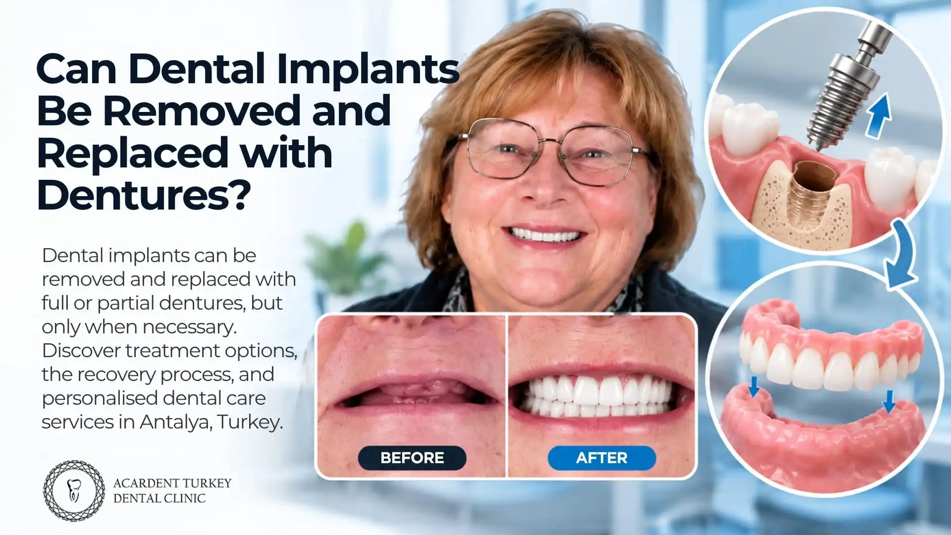 Can Dental Implants Be Removed and Replaced with Dentures?