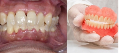 Can dentures be fitted to receding gums? Antalya Turkey