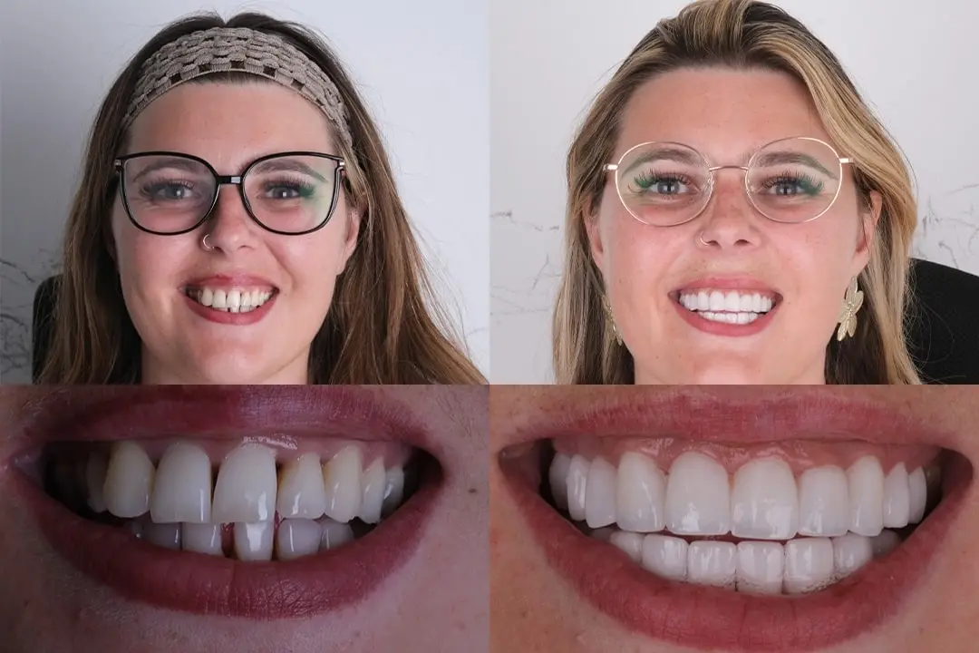 Can you have dental veneers with gum disease? Can you have dental veneers with gum disease?