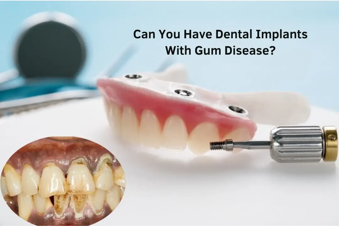 Can you have dental implants with gum disease?