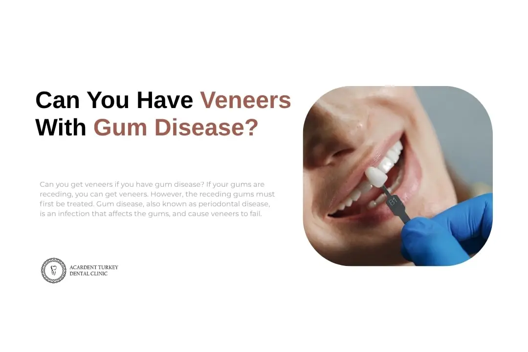 Can you have veneers teeth with gum disease?