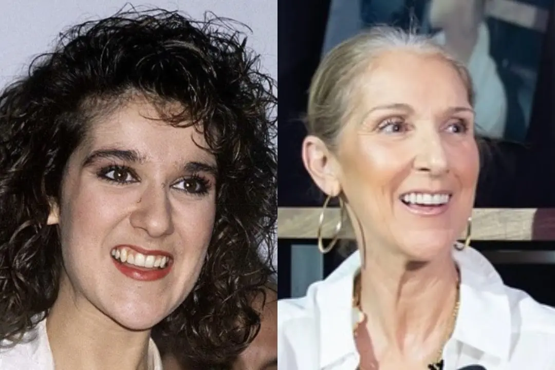 Celine Dion teeth veneers before and after Celine Dion teeth veneers Antalya, Turkey