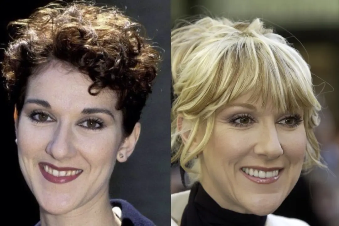 Celine Dion teeth before and after Celine Dion teeth Antalya, Turkey