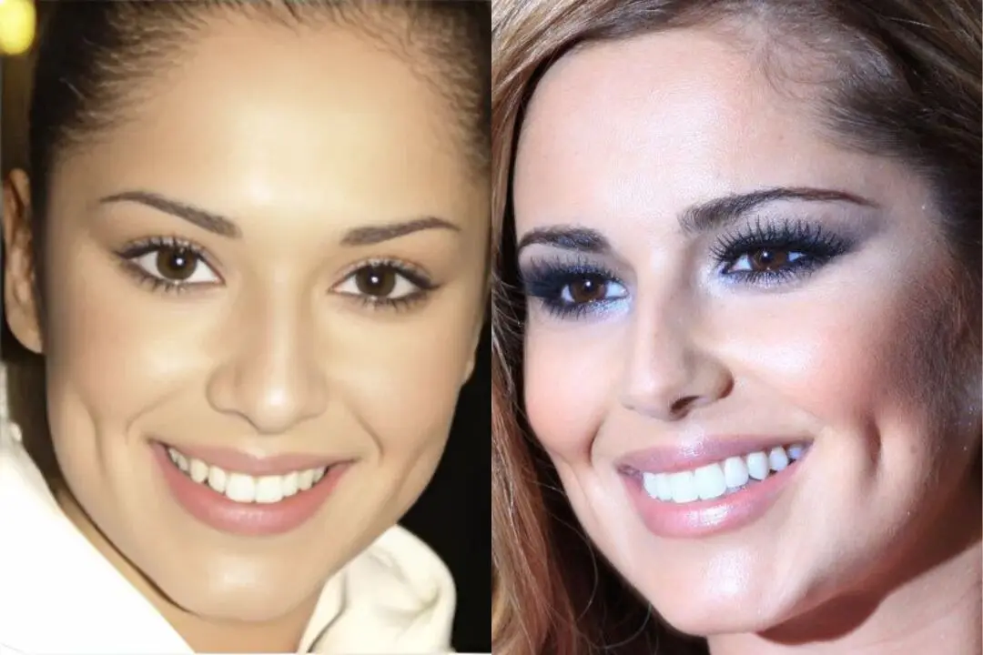 Cheryl Cole teeth veneers before and after Antalya, Turkey