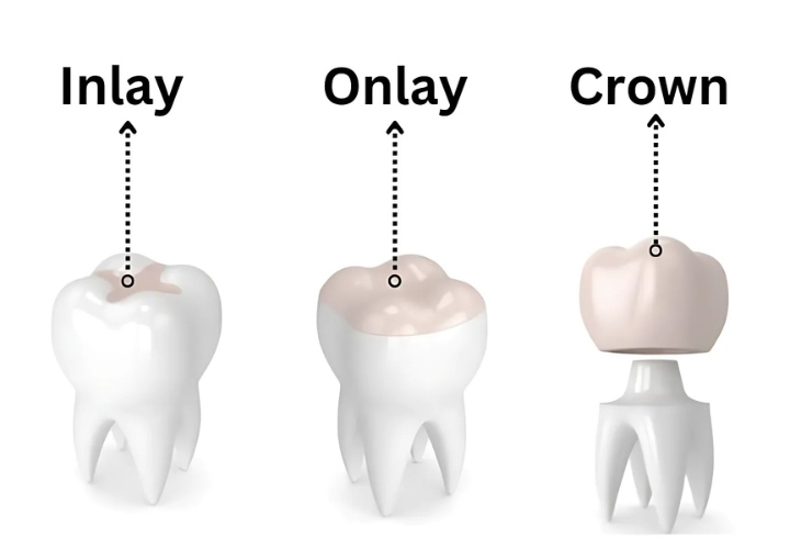 Composite inlays and onlays Antalya Turkey