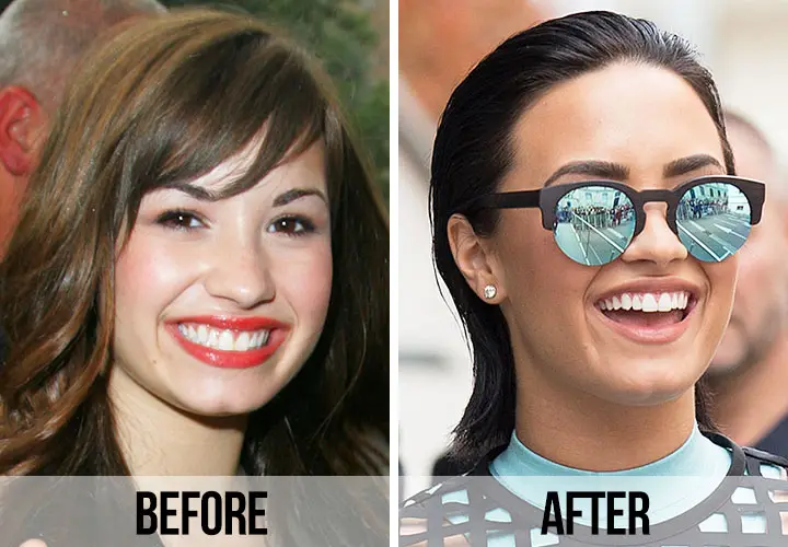  Celebrity veneers before and after Antalya, Turkey