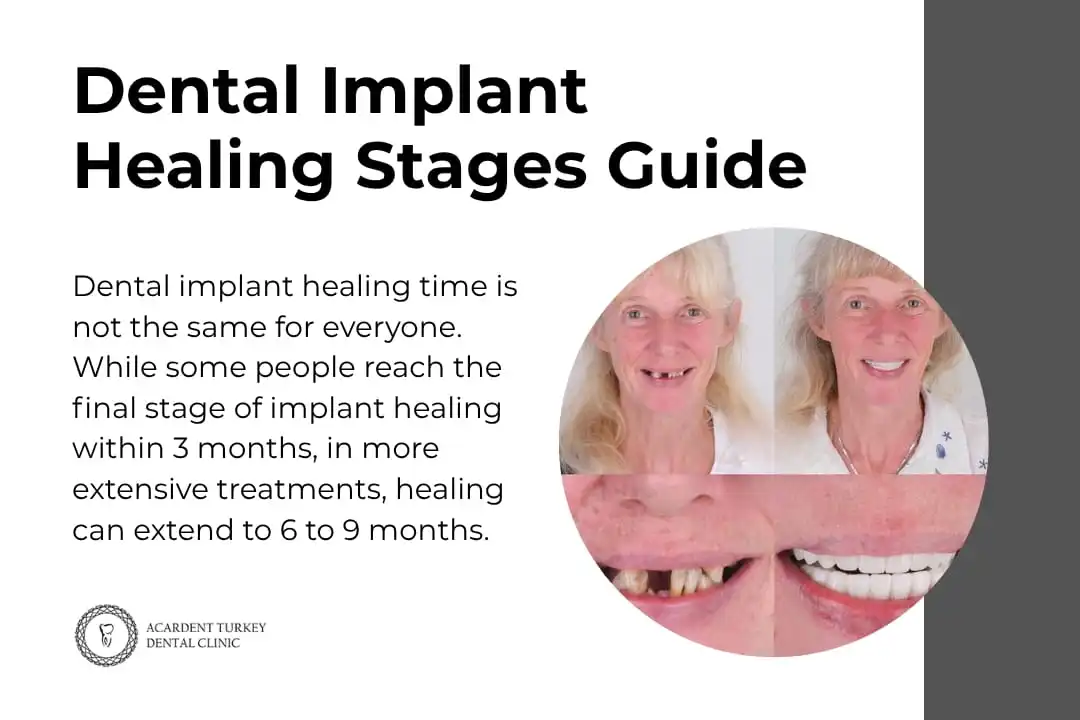 Dental Implant Healing Stages Guide - Acardent Turkey Clinic