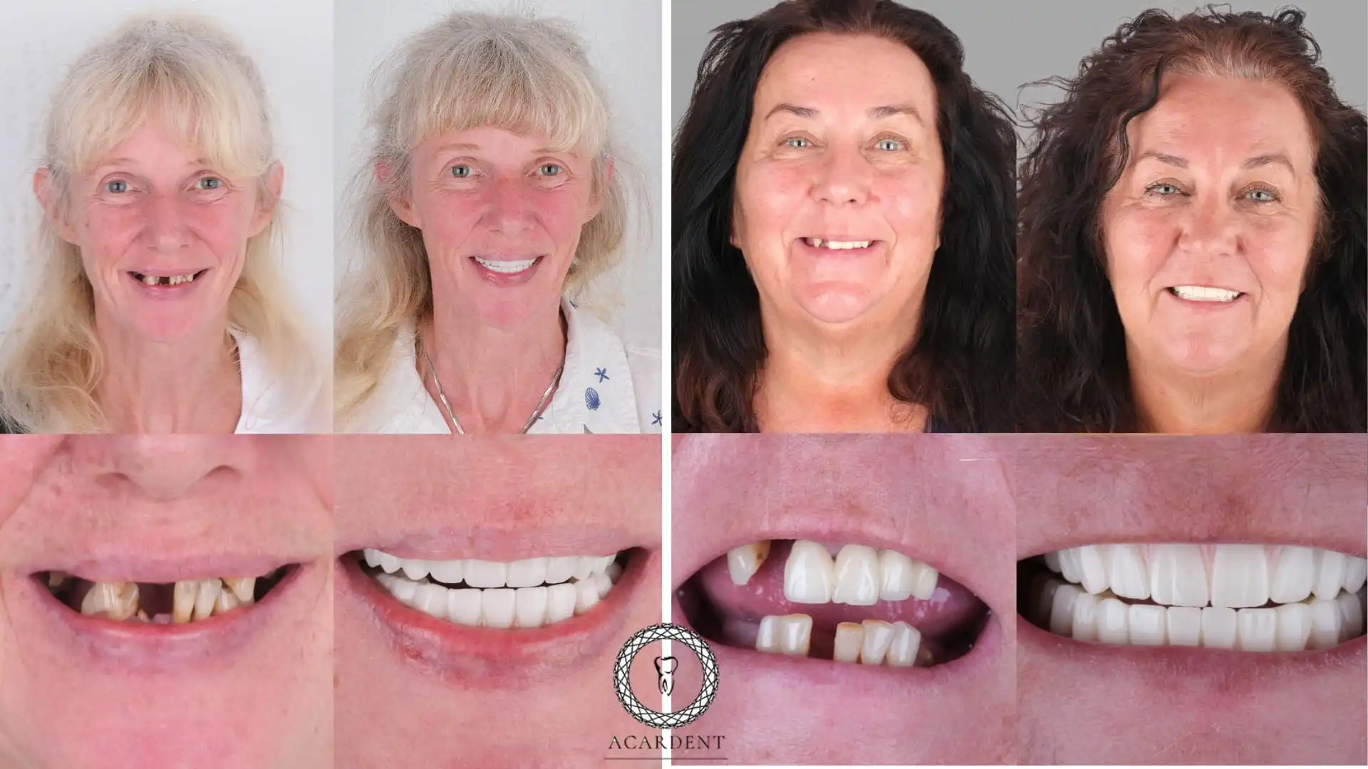 Dental implant healing process timeline