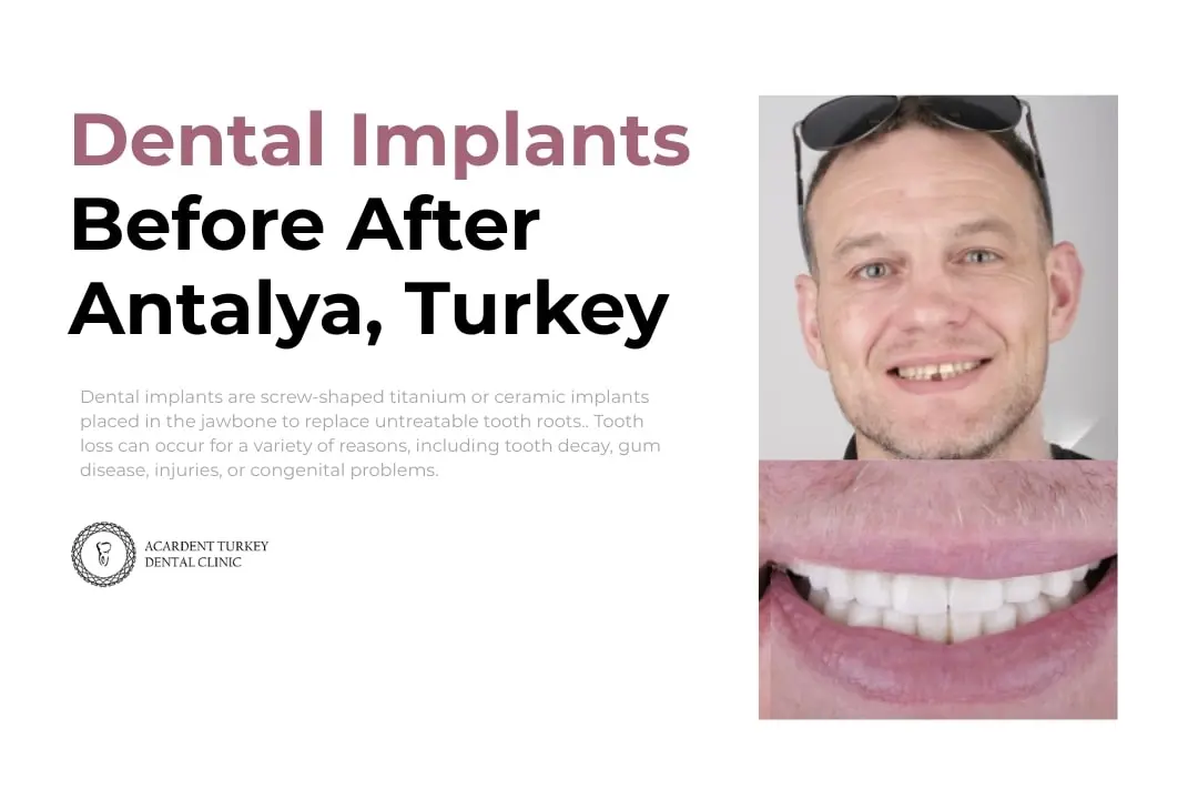 Dental Implants Before After Antalya, Turkey