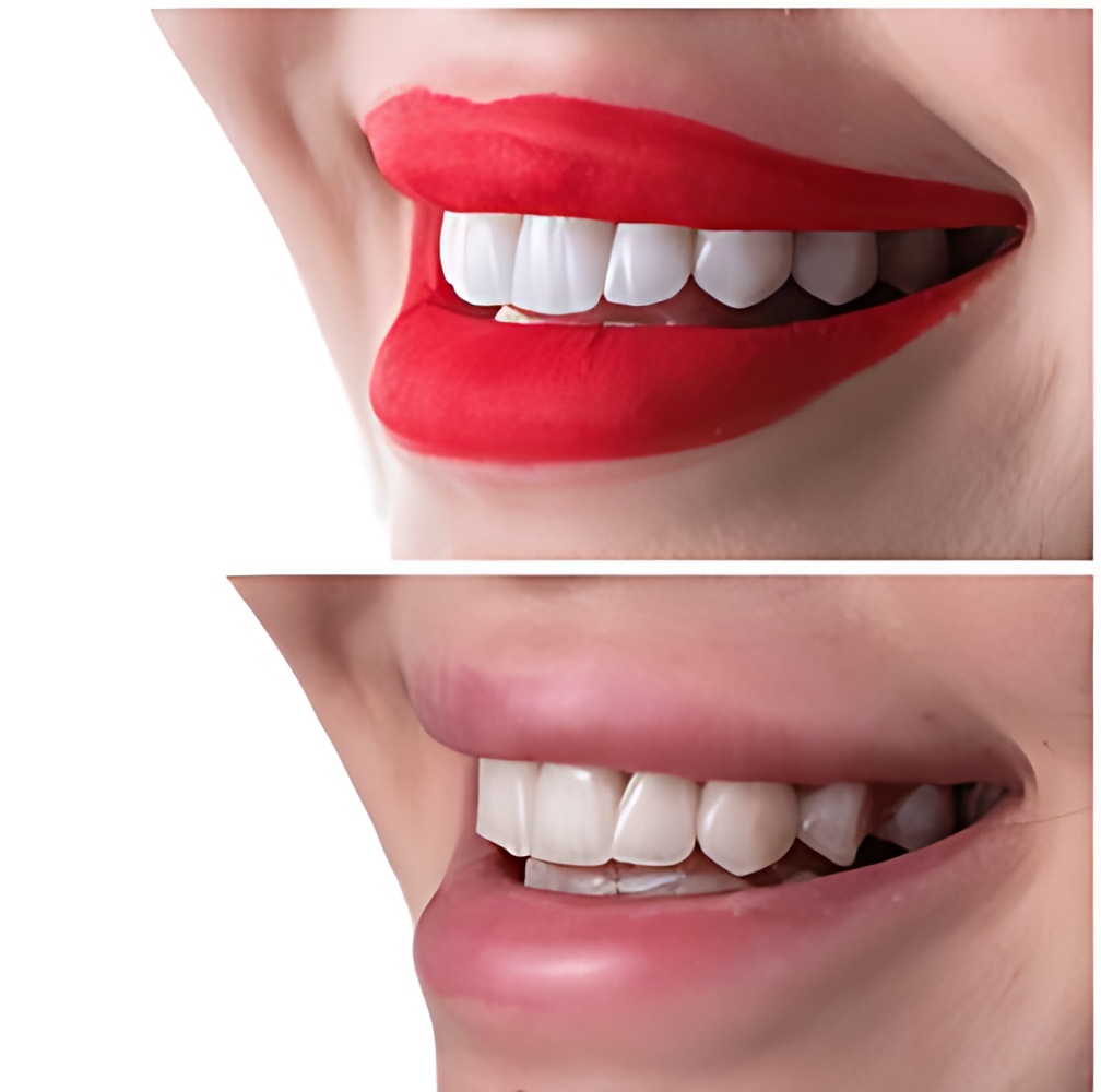 emax-veneers-before-after-turkey-antalya