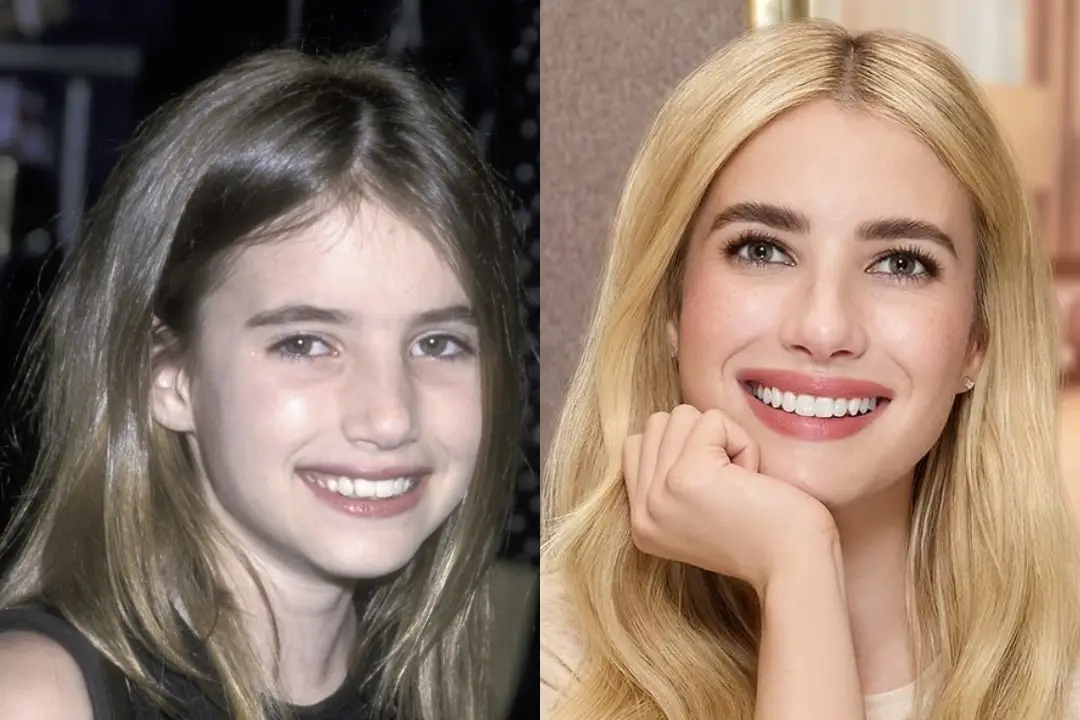 Emma Roberts teeth before and after Emma Roberts teeth before and after Antalya, Turkey